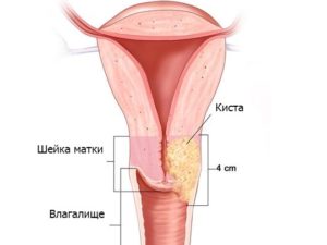 Множественные кисты на шейке матки