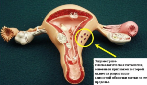 Чистка матки при эндометриозе