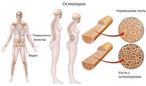 Как понять, что начался остеопороз при климаксе