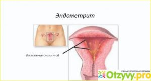 Гнойный эндометрит у женщин