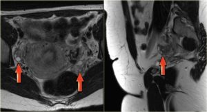 МРТ матки и яичников