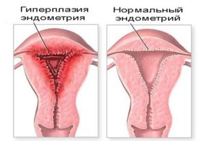 Гпэ в гинекологии что это