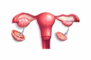 Дисфункция яичников: симптомы и методы лечения