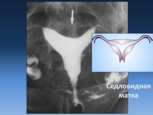 Что значит седловидная форма матки