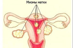 Причины возникновения миомы матки у женщин