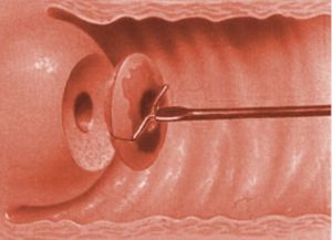 Что такое радиоволновая конизация шейки матки