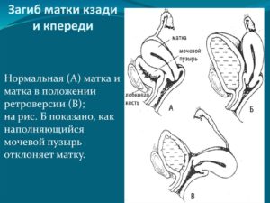 Как вылечить загиб матки