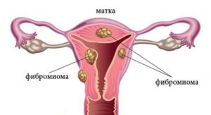 Субсерозный узел в матке