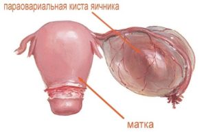 Паратубарная киста что это такое