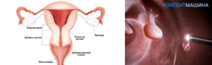 Причины возникновения полипа цервикального канала