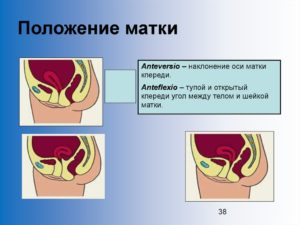 Антефлексия матки