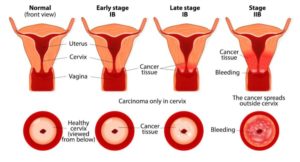 Стадии рака шейки матки