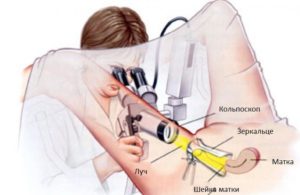 Как проходит процедура кольпоскопия шейки матки