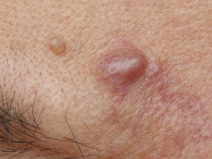Воспаление желез в паху у женщин