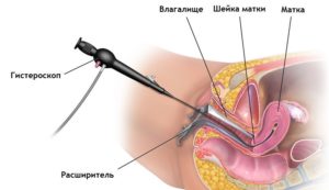 Как подготовиться к гистероскопии матки при полипе