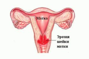 Почему из матки выходит воздух