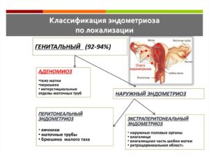 Наружный и экстрагенитальный эндометриоз