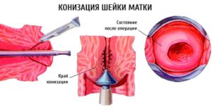 Лечение после конизации шейки матки