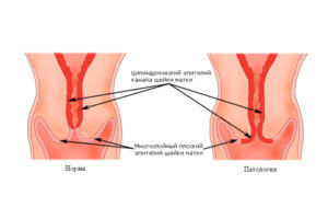 Что такое цилиндрический эпителий шейки матки