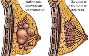 Как болит грудь при мастопатии