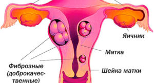 Что называют фиброзом матки