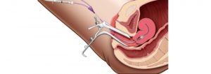 Удаление полипа эндометрия лазером