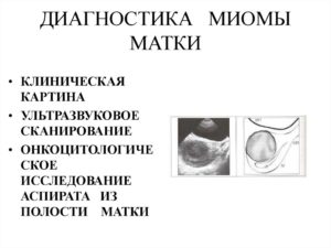 Диагностика миомы матки