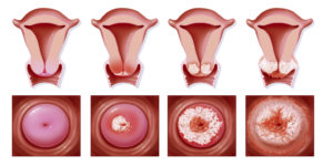 Что означает фиброз шейки матки