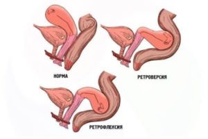 Что такое ретродевиация матки