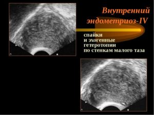 Эндометриоидные гетеротопии что это такое