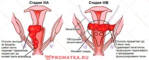 Рак шейки матки 3 стадии