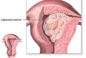 Симптомы и признаки рака эндометрия матки