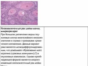 Прогноз при плоскоклеточном неороговевающем раке шейки матки