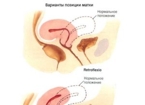 Матка отклонена кпереди