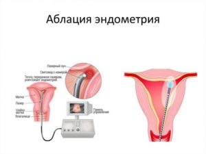 Гиперплазия эндометрия матки в менопаузе и постменопаузе