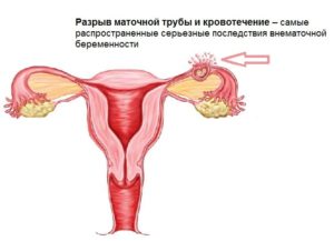 Можно ли сохранить трубу при внематочной беременности