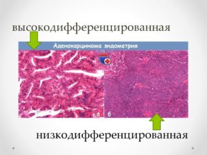 Низкодифференцированная аденокарцинома матки