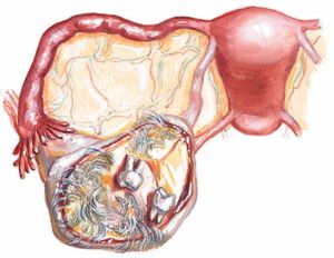 Тератома яичника: что это такое у женщин