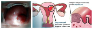 Что такое гиперплазия шейки матки