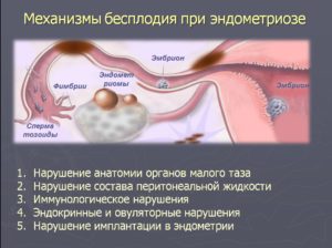 Можно ли вылечить бесплодие у женщин