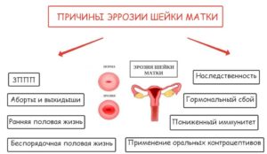 Современные способы лечения эрозии шейки матки