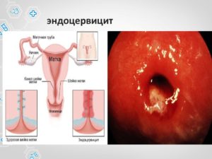 Симптомы и признаки эндоцервицита