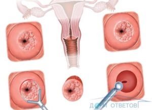 Что означает чистая шейка матки