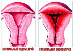 Патология эндометрия матки