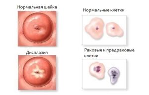 Кольпоскопия при патологиях шейки матки