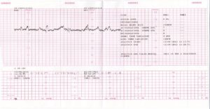КТГ плода при беременности: показатели, результаты