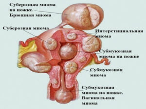 Может ли миома рассосаться при беременности