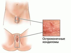 Кандиломатоз остроконечные кондиломы у женщин лечение