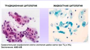 Что называют цитограммой шейки матки