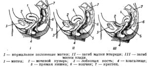 Загиб матки кпереди